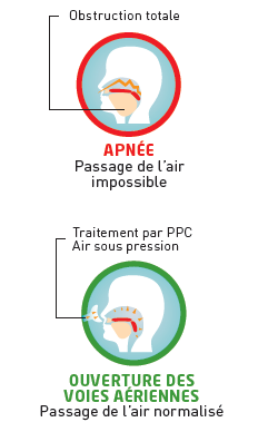 Le Syndrome D Apnee Du Sommeil Insv Institut National Du Sommeil Et De La Vigilance